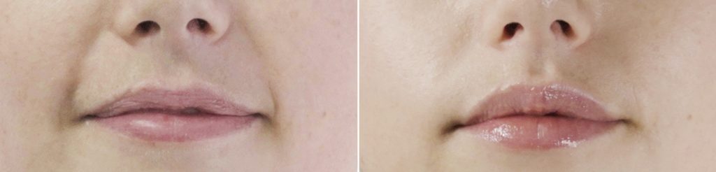 Before & after showing of the lips showing amazing and visible results after a Seventy Hyal 2000 skin booster treatment