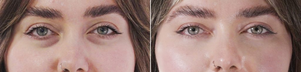 Before & after pf the under eye showing amazing and visible results after a Seventy Hyal 2000 skin booster treatment