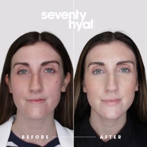Seventy Hyal 2000 Before And After