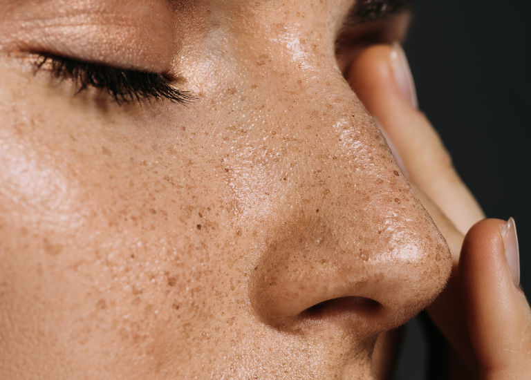 Skin boosters in winter