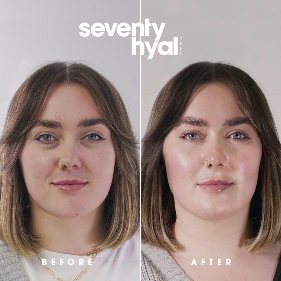 Seventy Hyal results